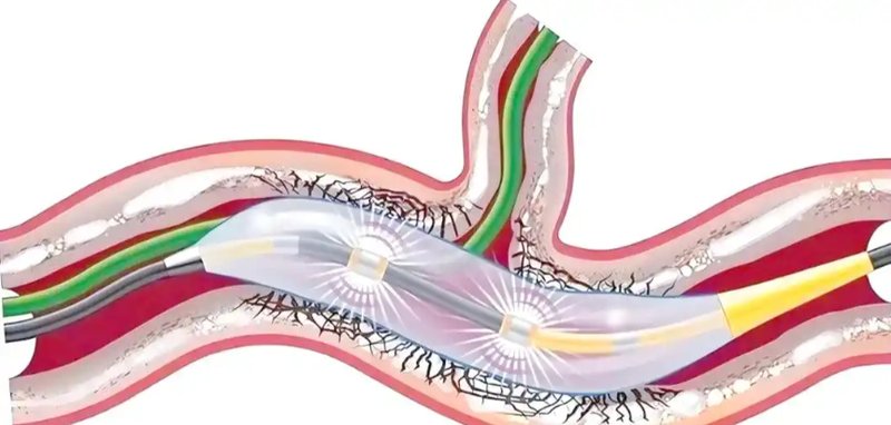 【技术突破】88岁老人的心脏“破壁”记:OCT+振波球囊联合术式全解析 新闻